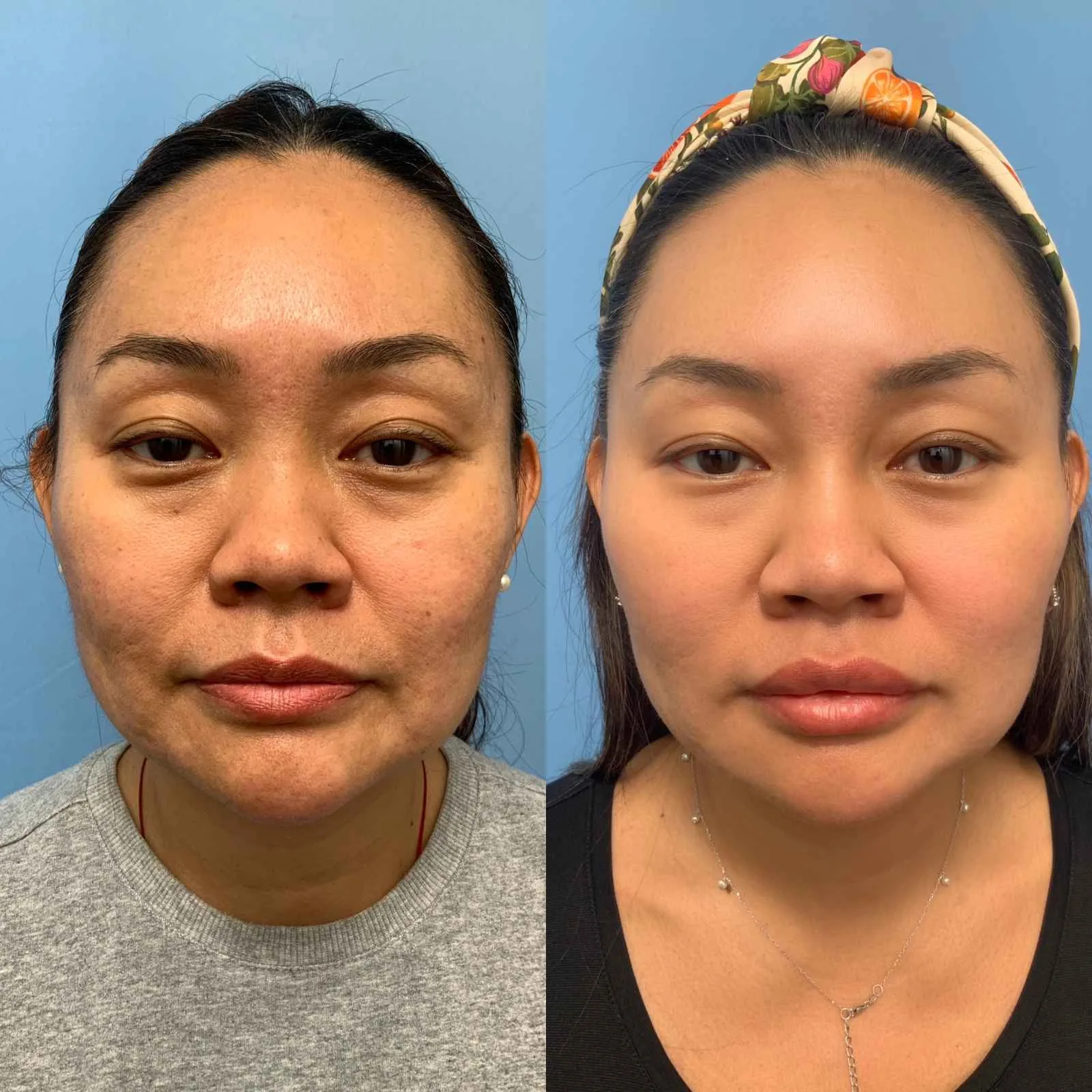 Morpheus8 Treatment