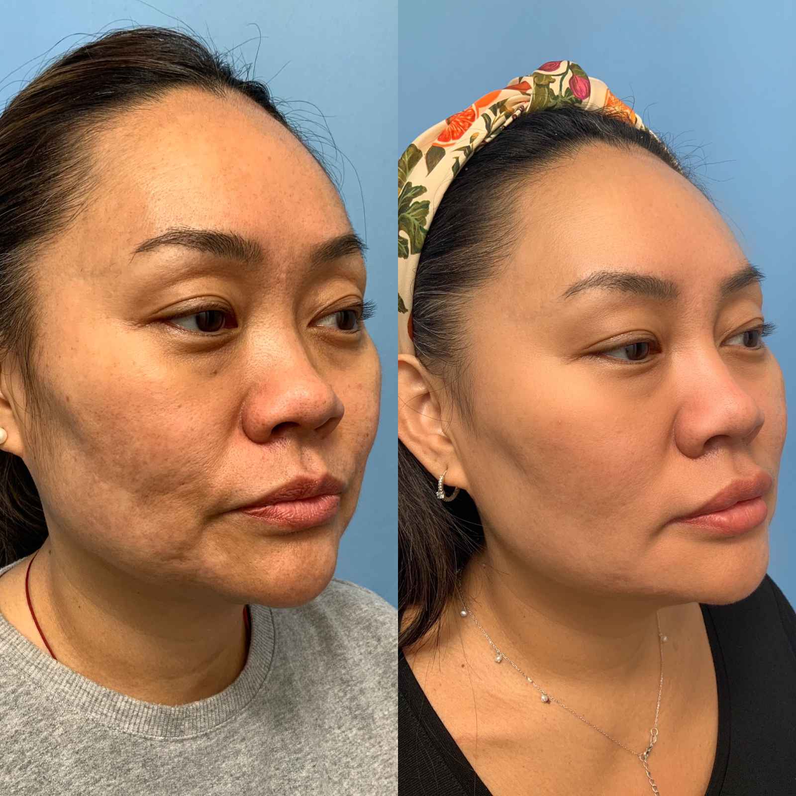 Before and after oblique view photos of a woman following Morpheus8 treatment, showing reduced hyperpigmentation, improved skin texture, and a firmer, more contoured appearance along the cheeks and jawline.