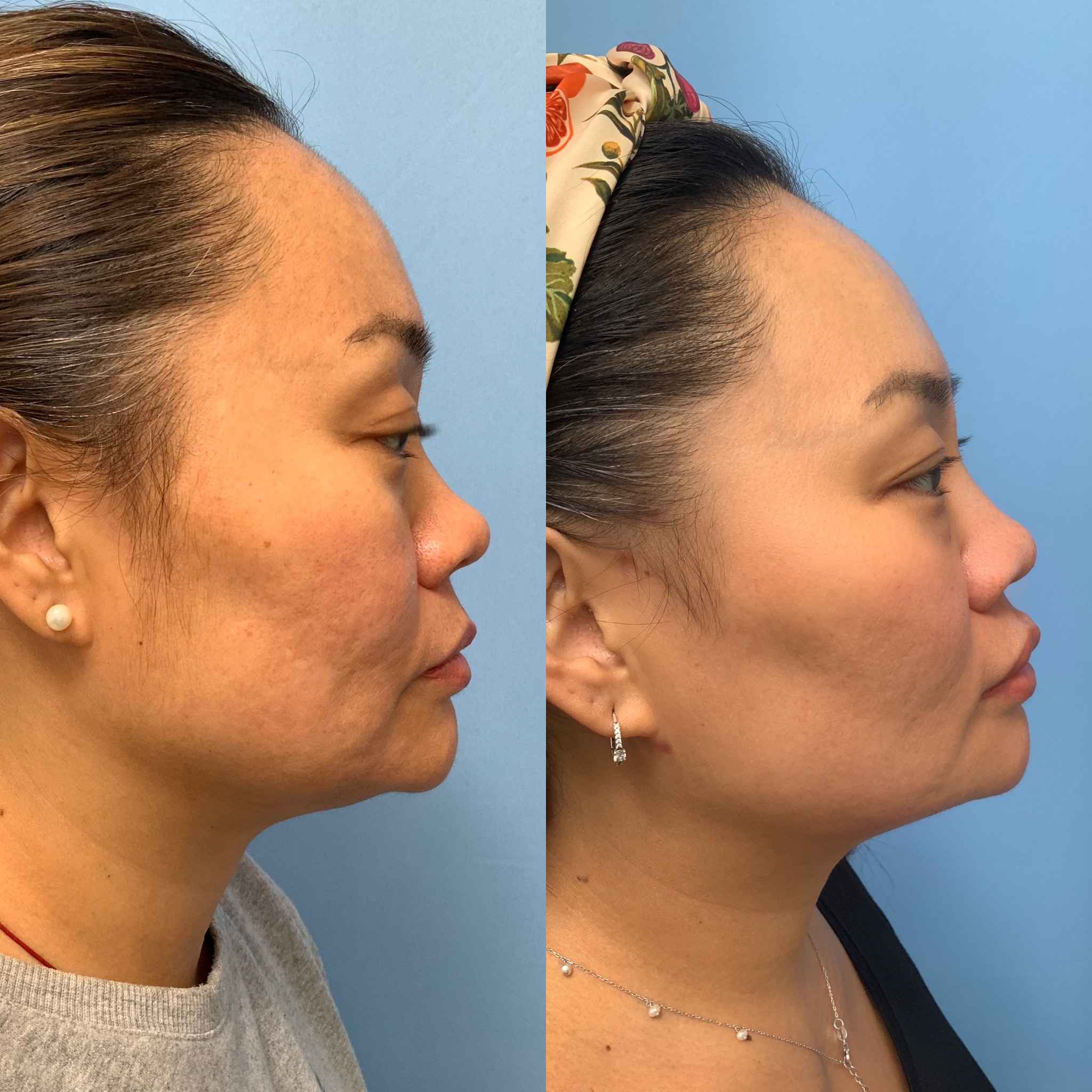 Before and after lateral view photos of a woman following Morpheus8 treatment, showing reduced skin laxity, improved jawline definition, and firmer skin along the lower face and neck.