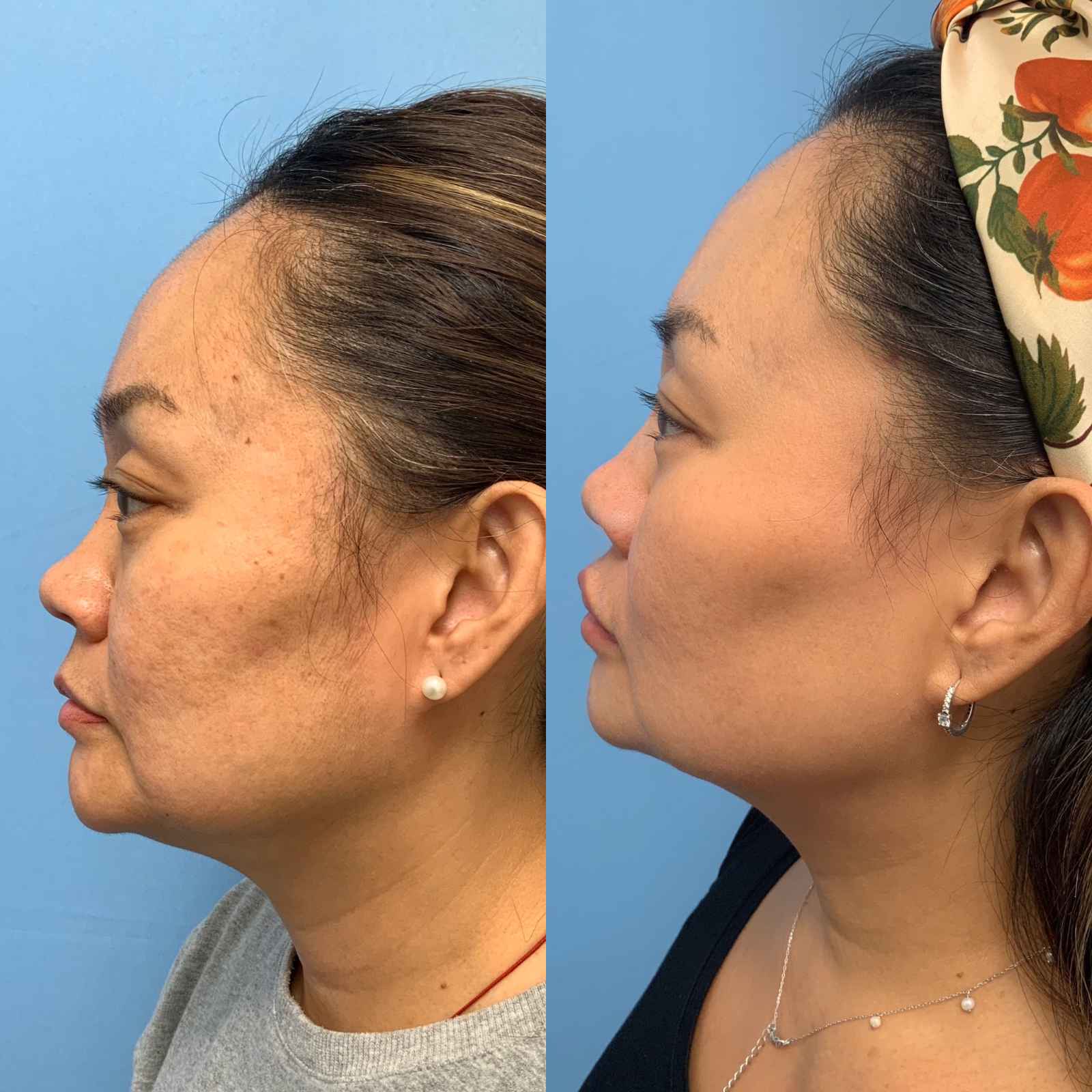 Before and after lateral view photos of a woman following Morpheus8 treatment, showing improved skin firmness, reduced jowling, and a more defined jawline and neck contour.
