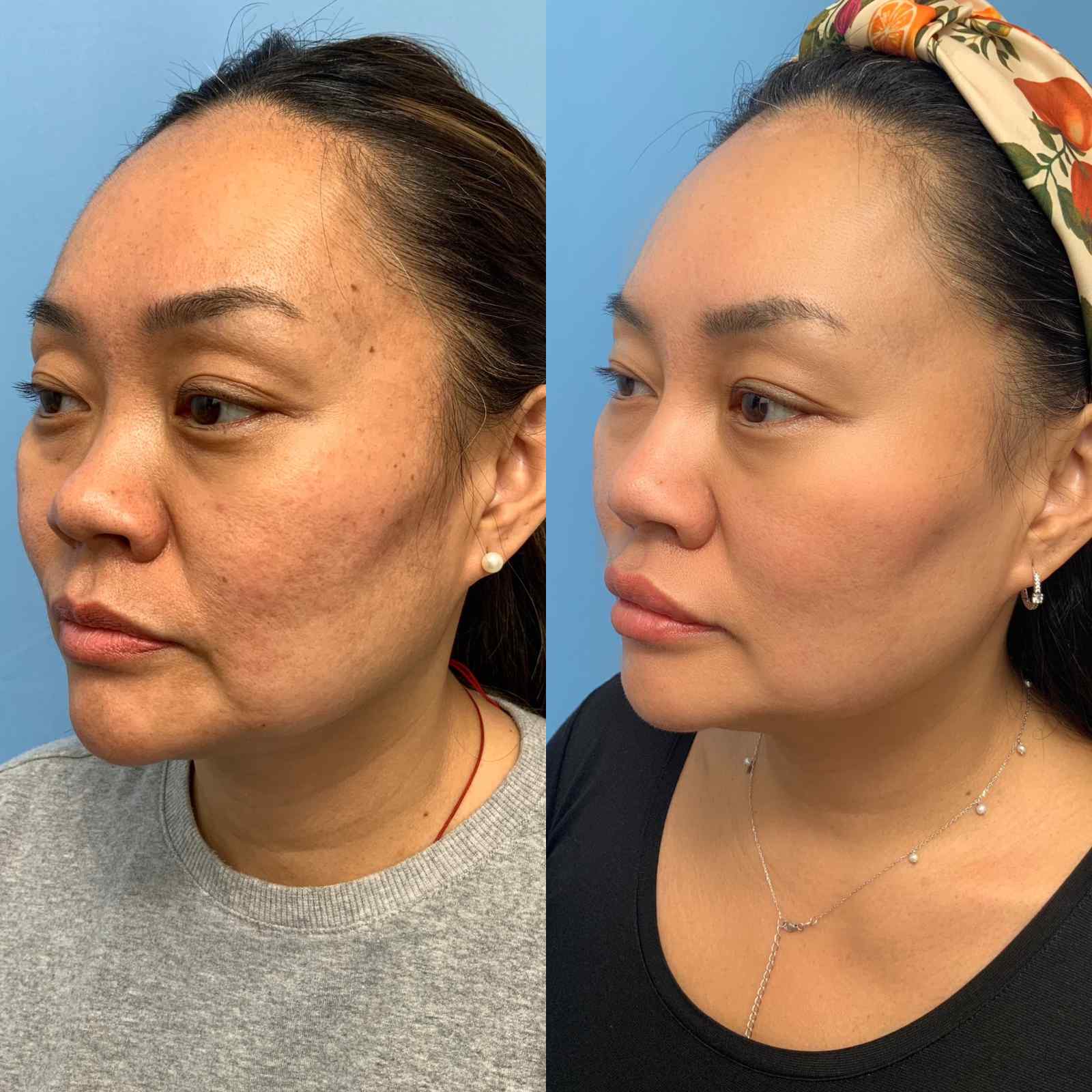 Before and after three-quarter view photos of a woman following Morpheus8 treatment, showing reduced hyperpigmentation, improved skin firmness, and a more defined jawline and cheek contour.
