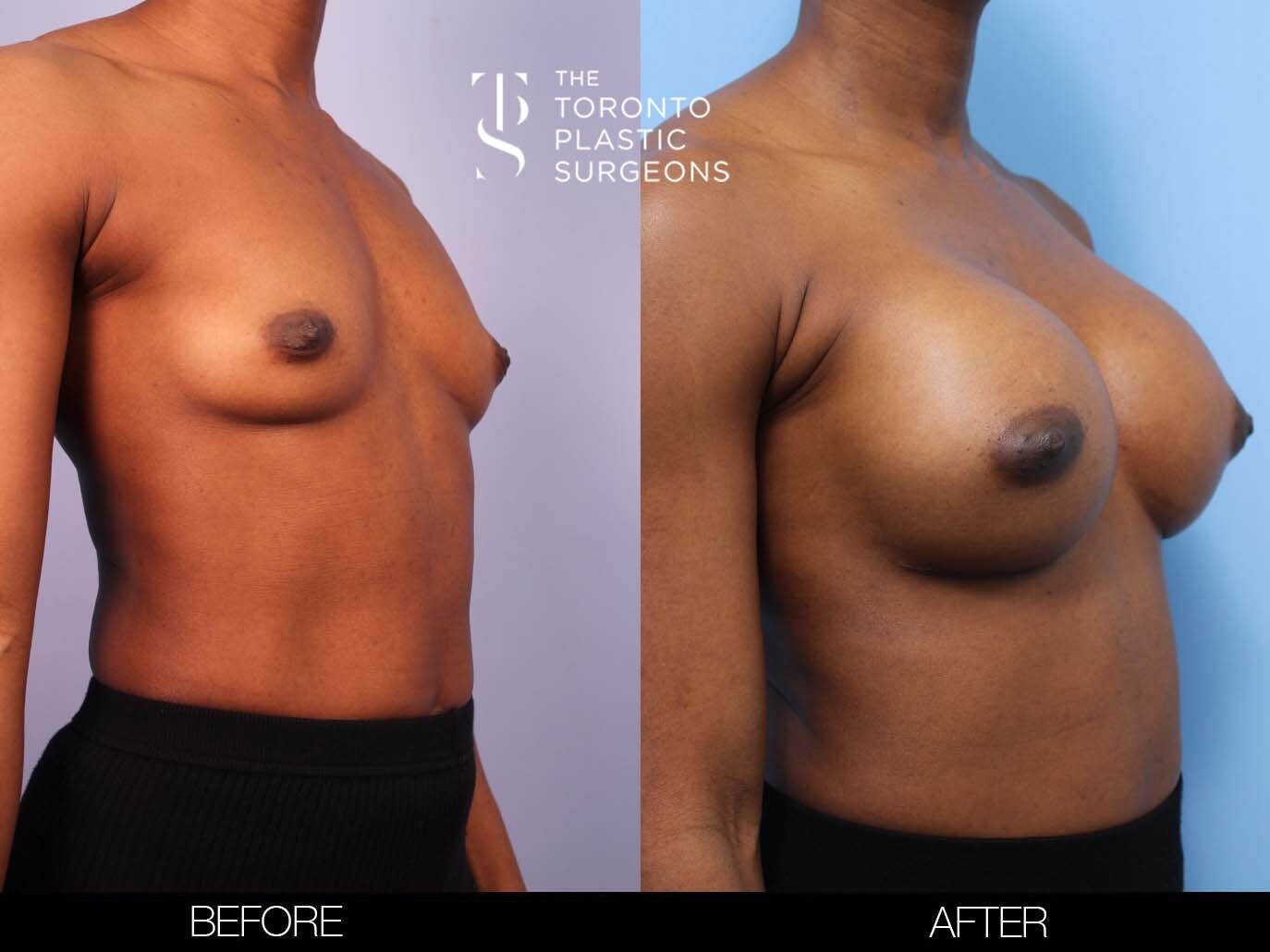 Before and after of breast implant surgery