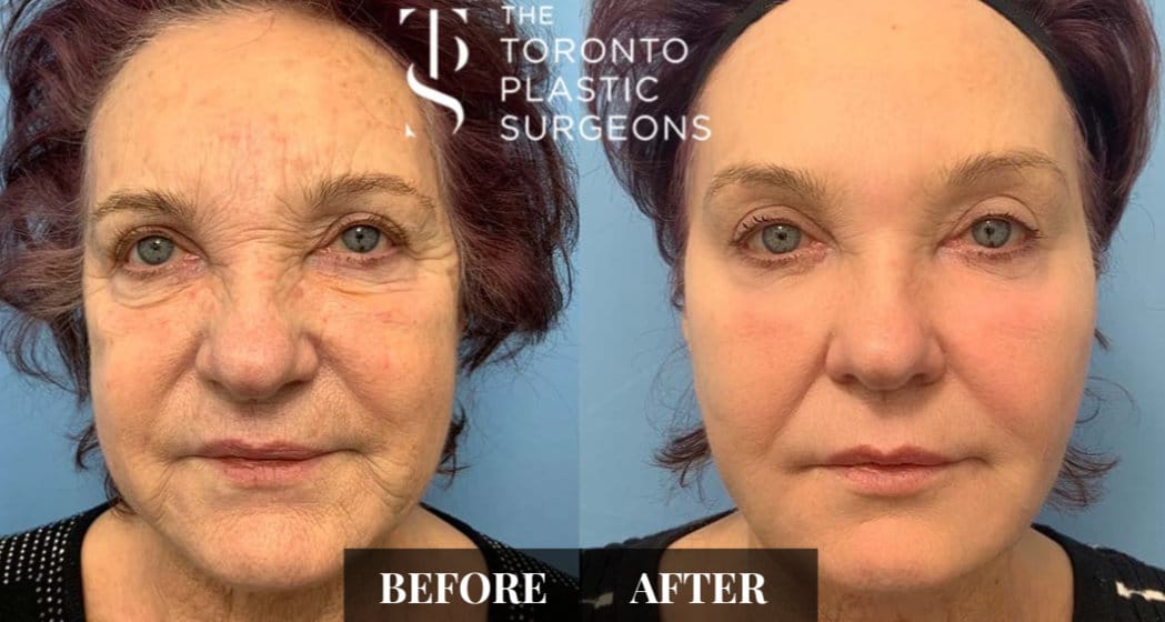 Front-view before and after comparison of a female patient who received CO2 laser resurfacing at The Toronto Plastic Surgeons, showing smoother skin with reduced deep wrinkles around the mouth and forehead and a more even complexion.