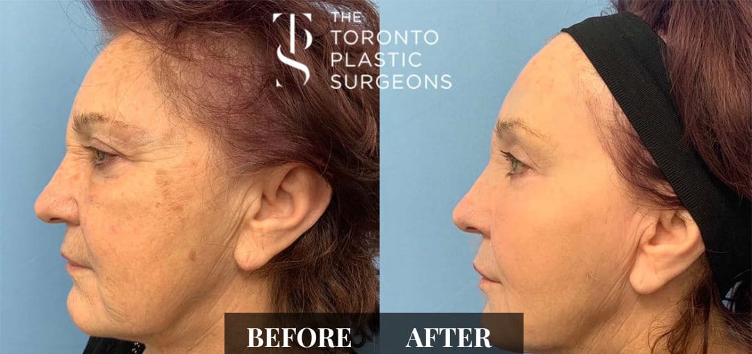 Left profile before and after comparison of a female patient who received CO2 laser resurfacing at The Toronto Plastic Surgeons, showing reduced wrinkles and pigmentation with smoother, tighter skin along the cheek and jaw.