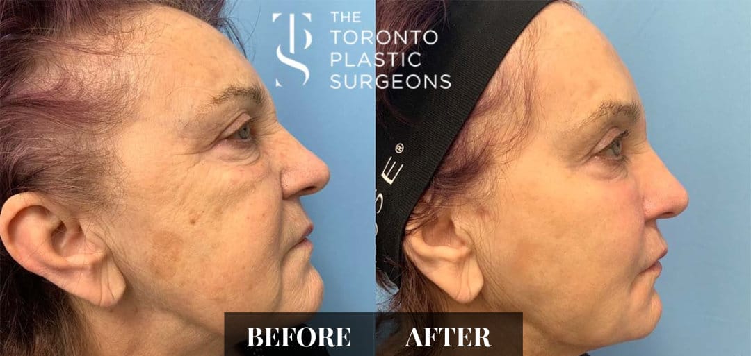 Right profile before and after comparison of a female patient who received CO2 laser resurfacing at The Toronto Plastic Surgeons, showing softened deep lines and reduced sun damage with smoother skin texture across the cheek.