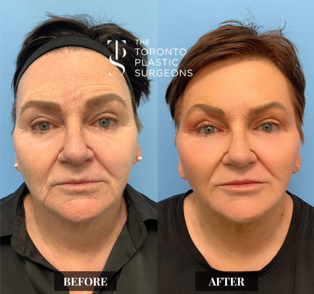 Front-view before and after comparison of a female patient who received CO2 laser resurfacing at The Toronto Plastic Surgeons, showing smoother skin with softened fine lines and wrinkles and a more even, refreshed complexion.
