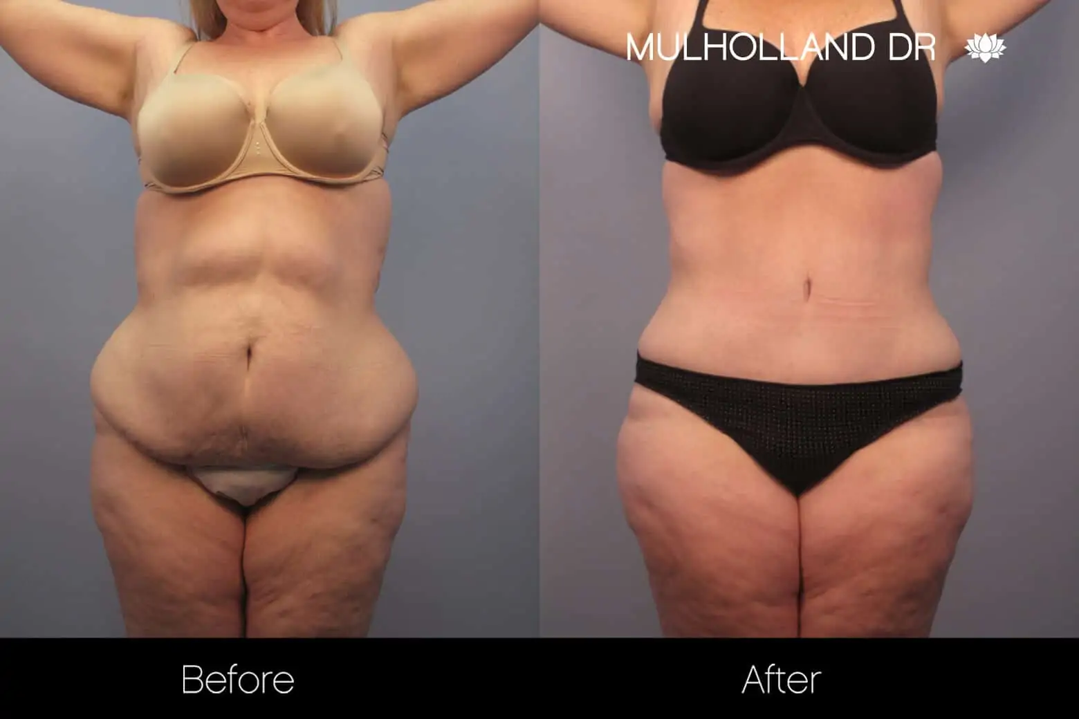 Mommy Makeover -Before and After Gallery - Patient Photo 24