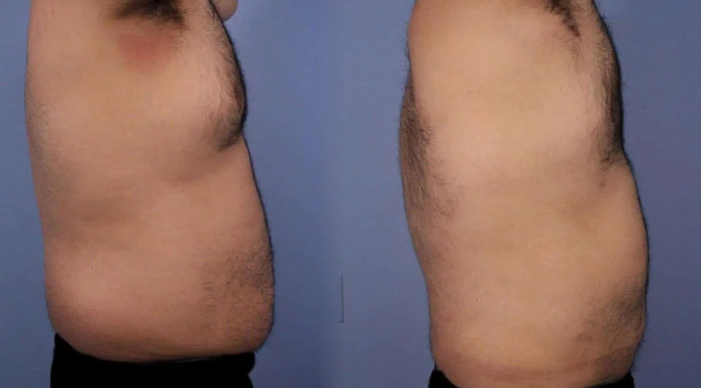 Abdomen Liposuction - Before and After Gallery - Patient Photo 10