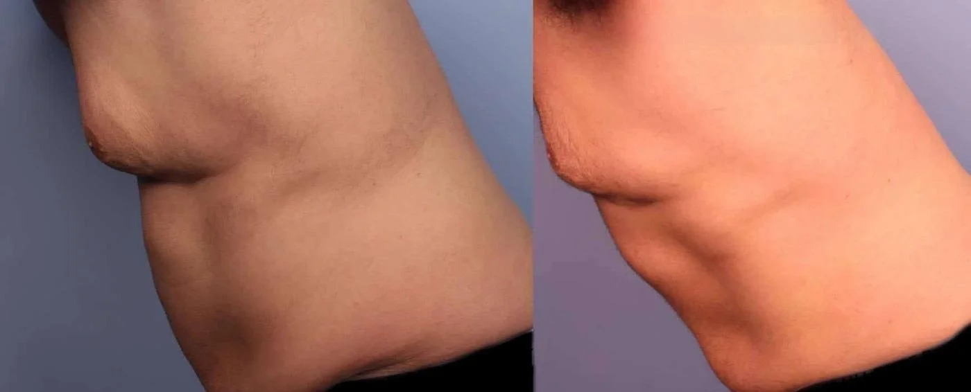 Abdomen Liposuction - Before and After Gallery - Patient Photo 12
