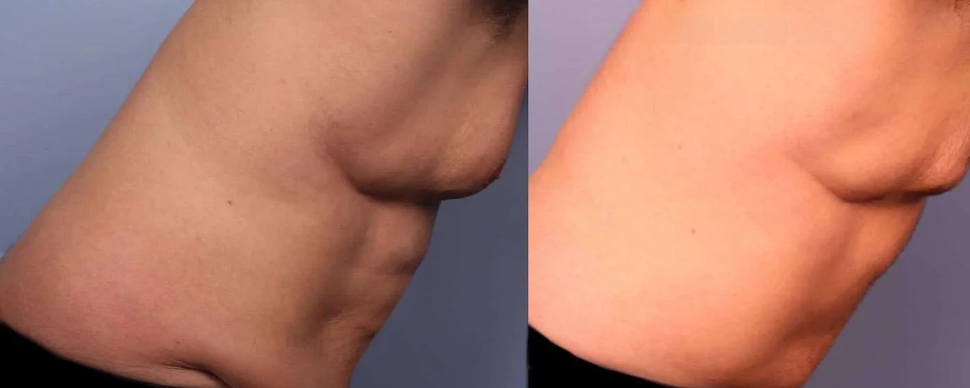 aAbdomen Liposuction - Before and After Gallery - Patient Photo 13