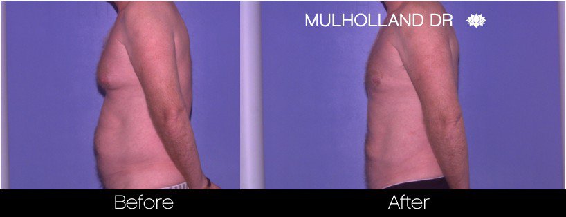 Abdomen Liposuction - Before and After Gallery - Patient Photo 18