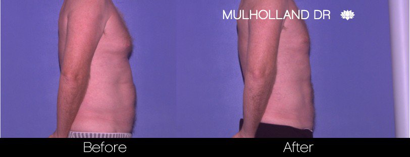 Abdomen Liposuction - Before and After Gallery - Patient Photo 19