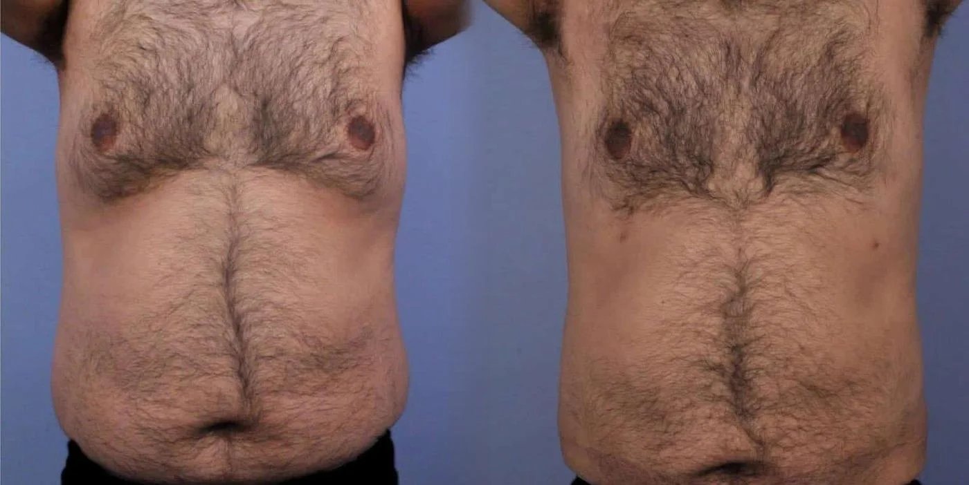 Abdomen Liposuction - Before and After Gallery - Patient Photo 6