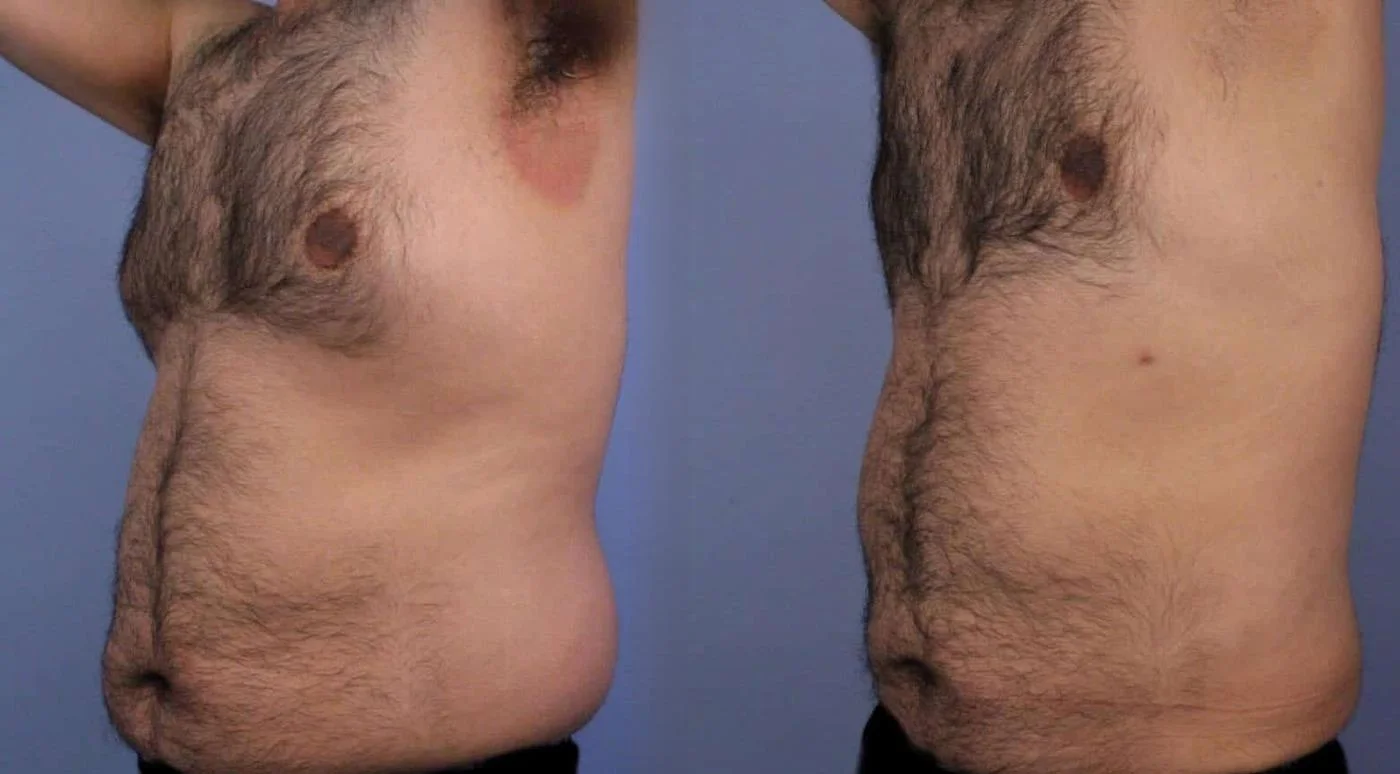 Love Handle Liposuction Before & After Photos
