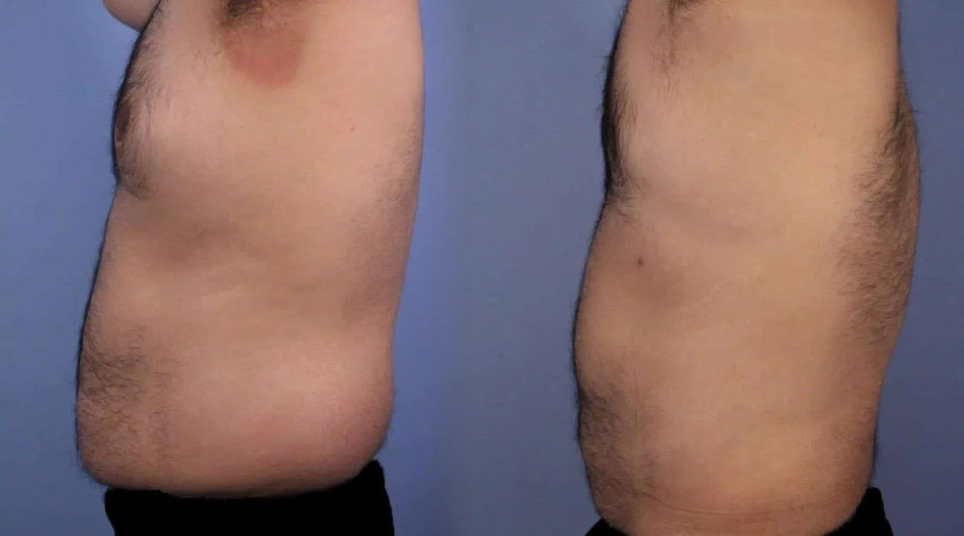 Abdomen Liposuction - Before and After Gallery - Patient Photo 8