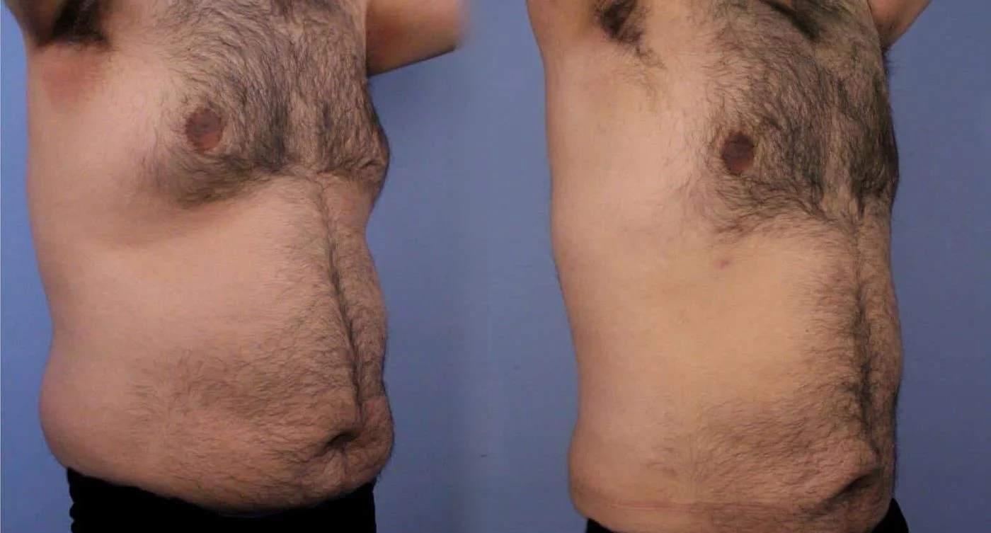 Abdomen Liposuction - Before and After Gallery - Patient Photo 9