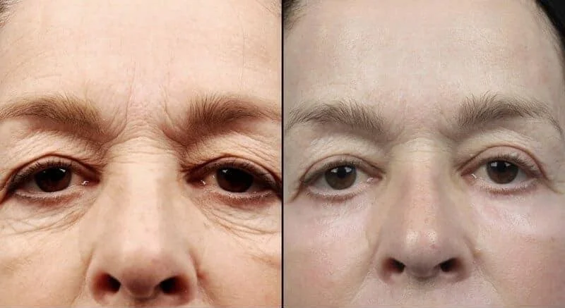 AccuTite - Before and After Gallery - Patient Photo 1