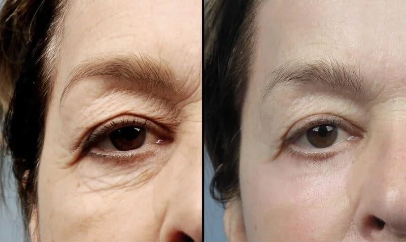 AccuTite - Before and After Gallery - Patient Photo 2