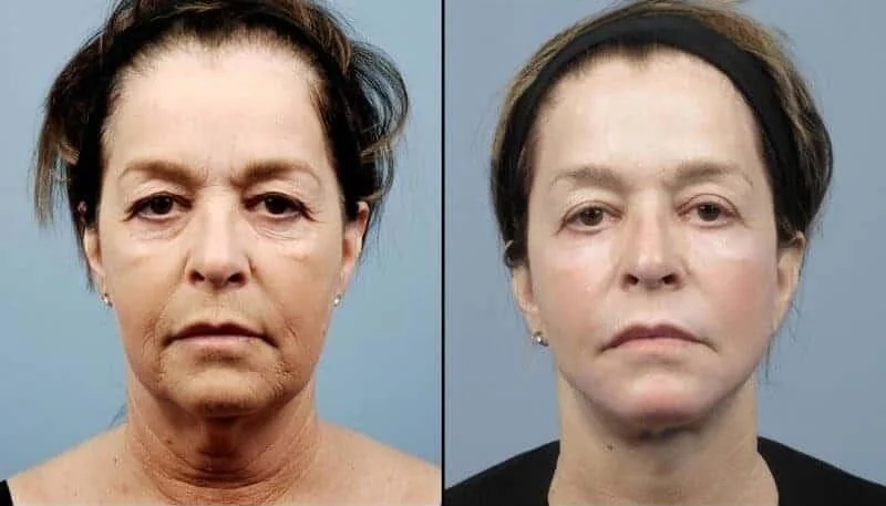 AccuTite - Before and After Gallery - Patient Photo 3