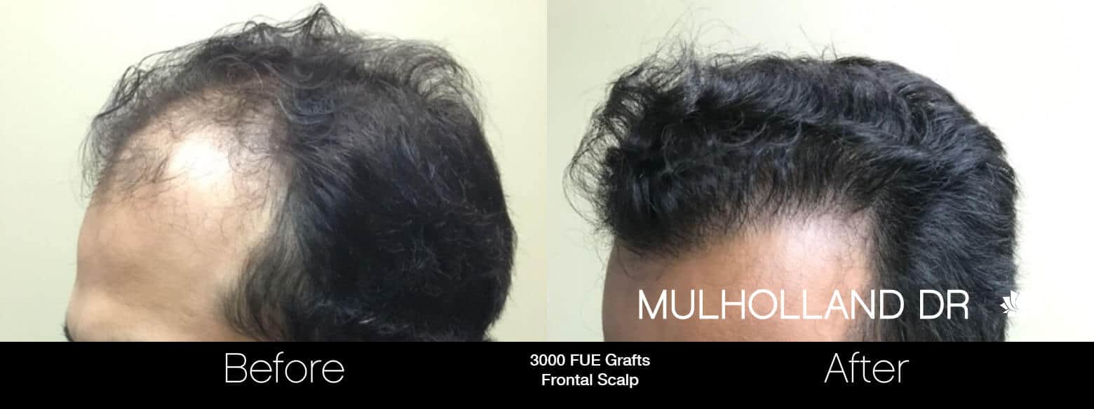 Artas Hair Transplant - Before and After Gallery - Patient Photo 12