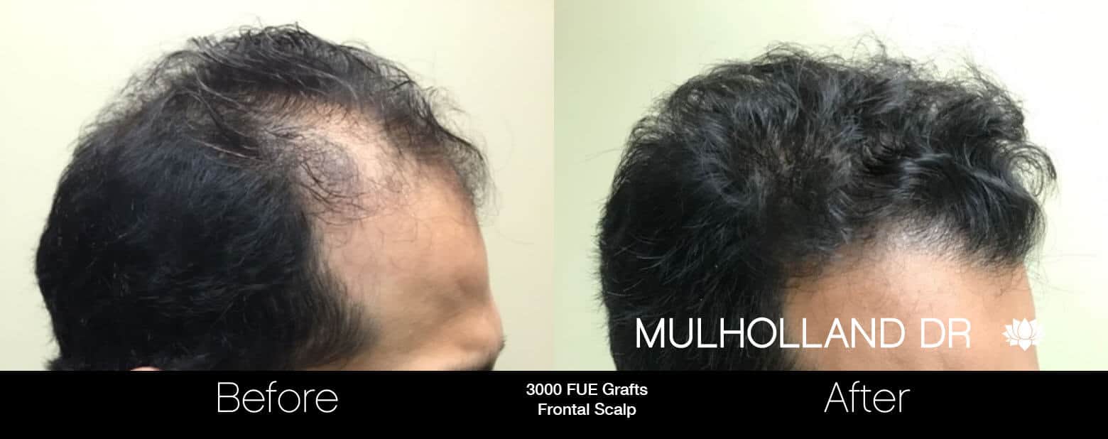 Toronto Neograft Hair Transplant Tps