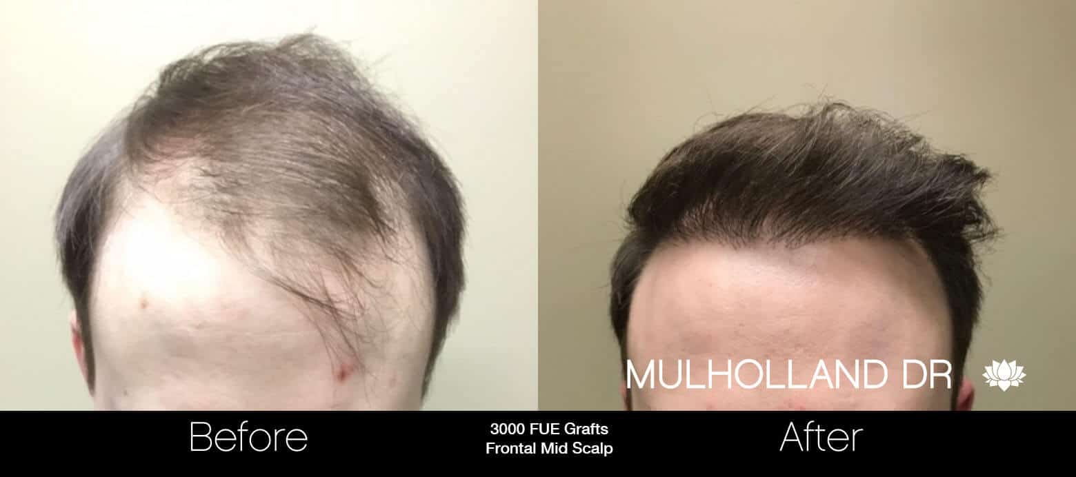 FUE Hair Transplant Before & After Photo Gallery | TPS