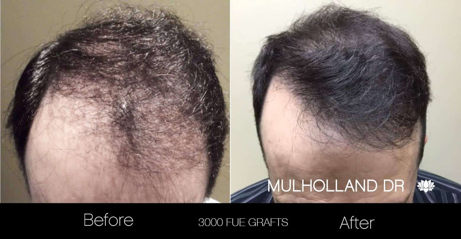 hair transplant before fue follicular unit extraction toronto artas