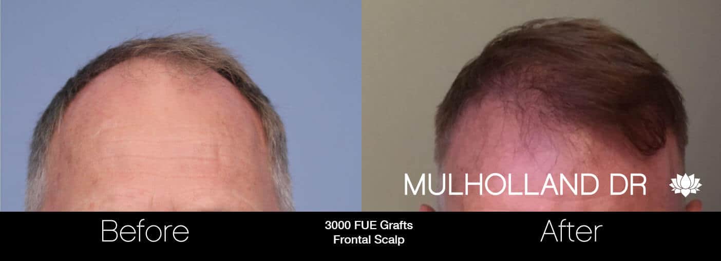 Artas Hair Transplant - Before and After Gallery - Patient Photo 26