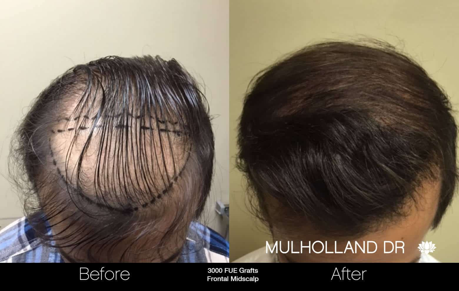 Artas Hair Transplant - Before and After Gallery - Patient Photo 29