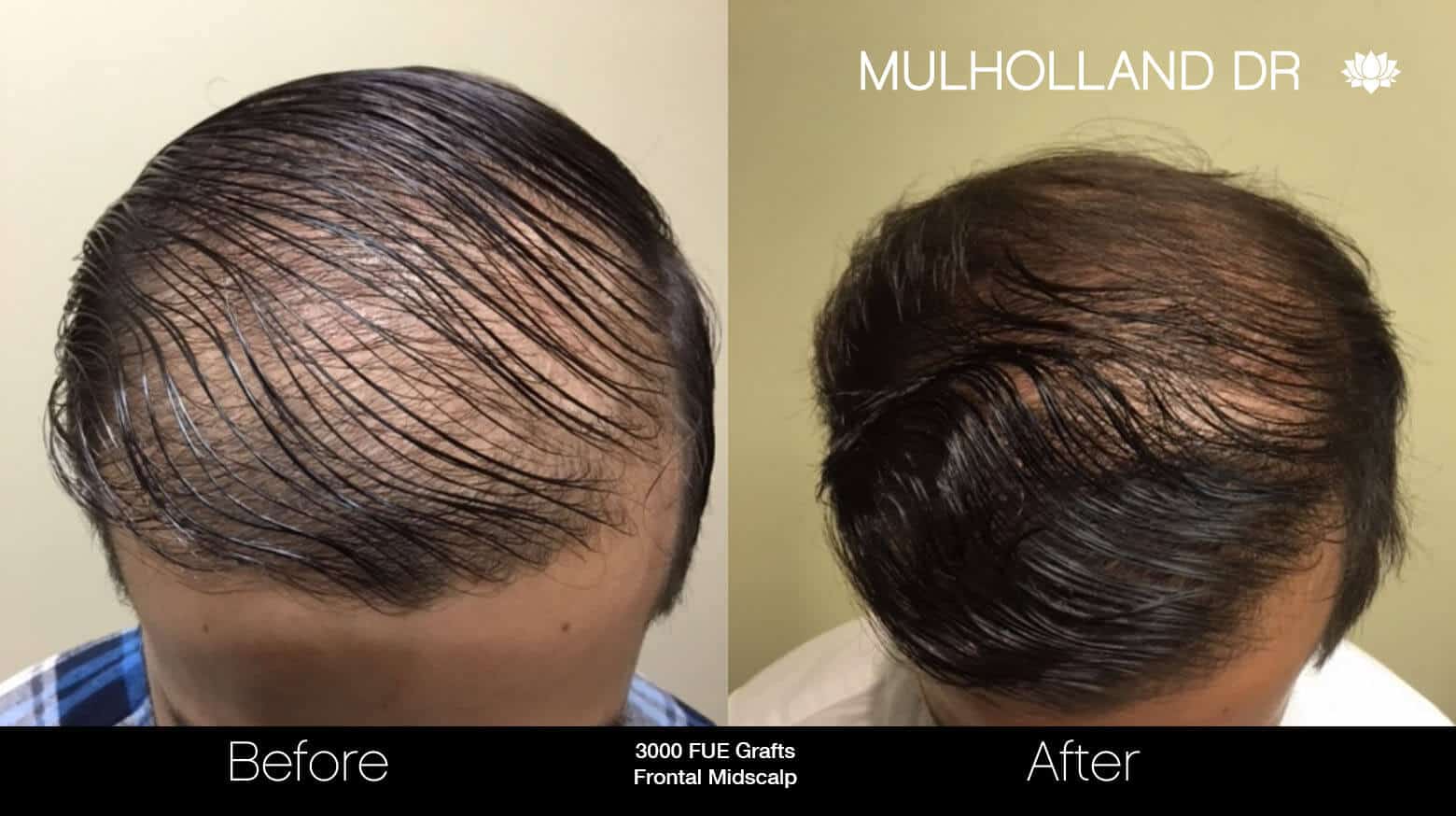 Artas Hair Transplant - Before and After Gallery - Patient Photo 32
