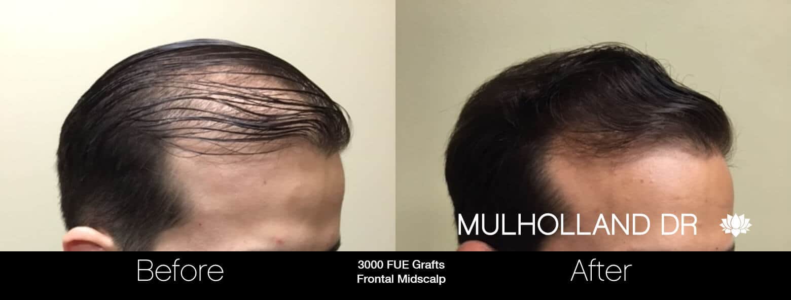 Artas Hair Transplant - Before and After Gallery - Patient Photo 33