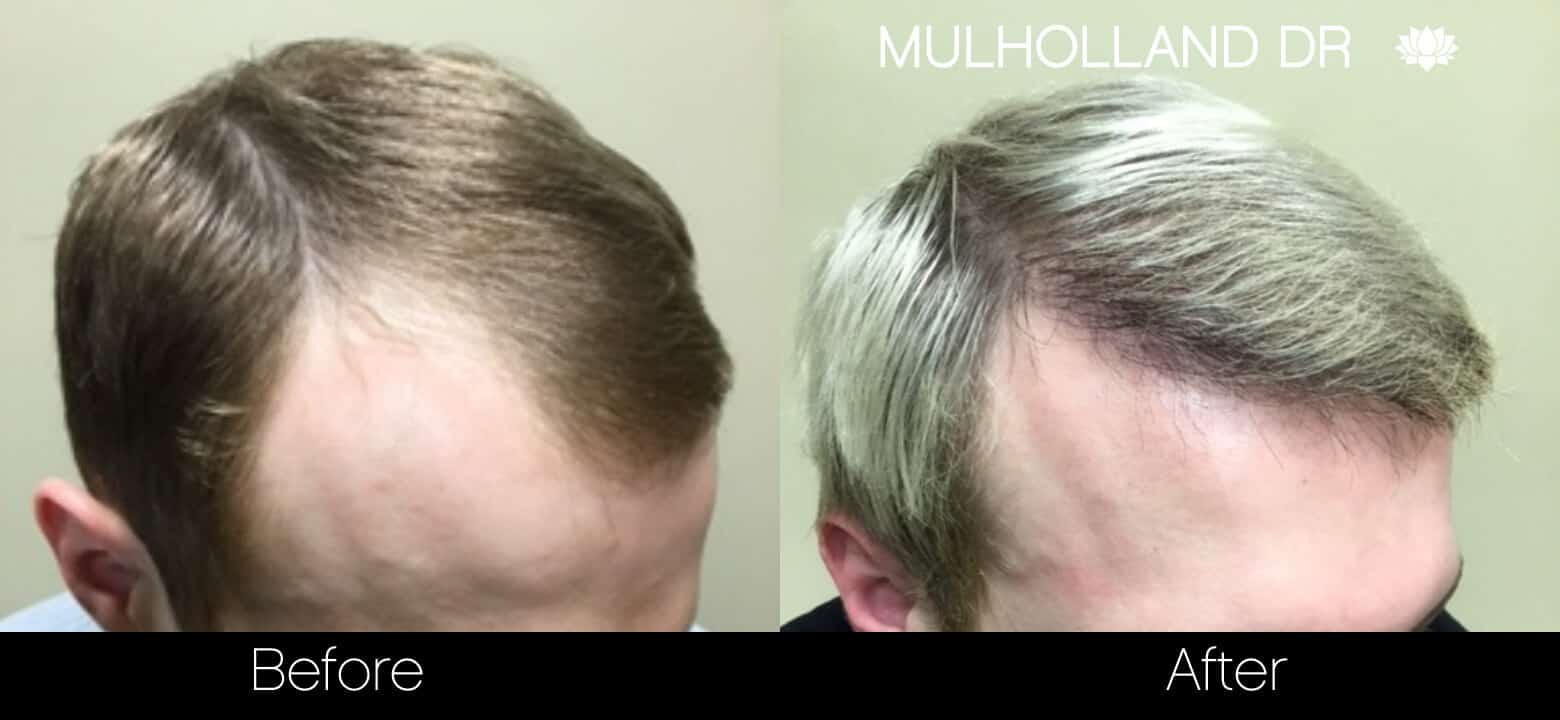 Artas Hair Transplant - Before and After Gallery - Patient Photo 35