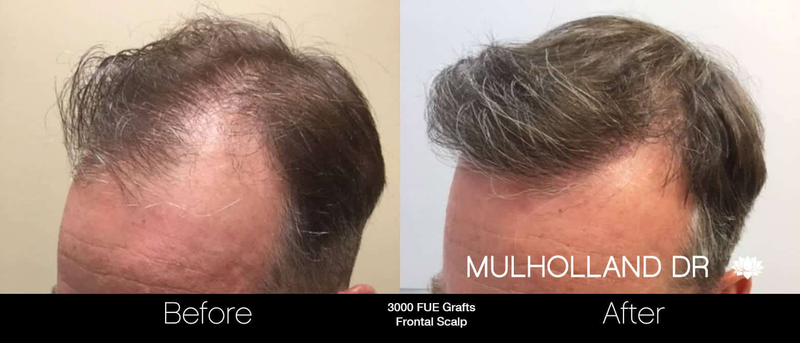 Artas Hair Transplant - Before and After Gallery - Patient Photo 62