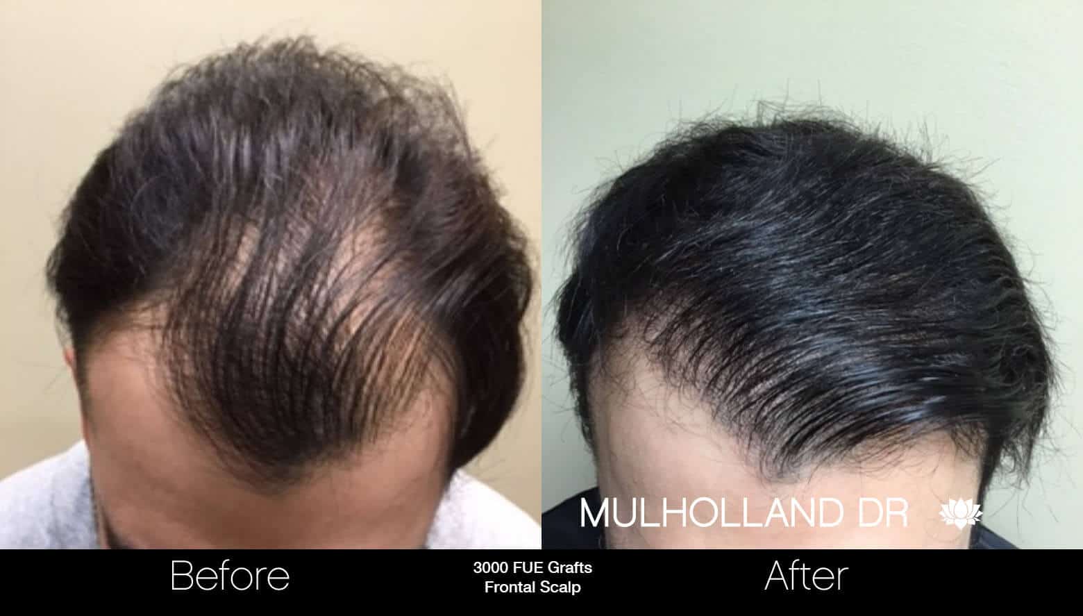 Artas Hair Transplant - Before and After Gallery - Patient Photo 72