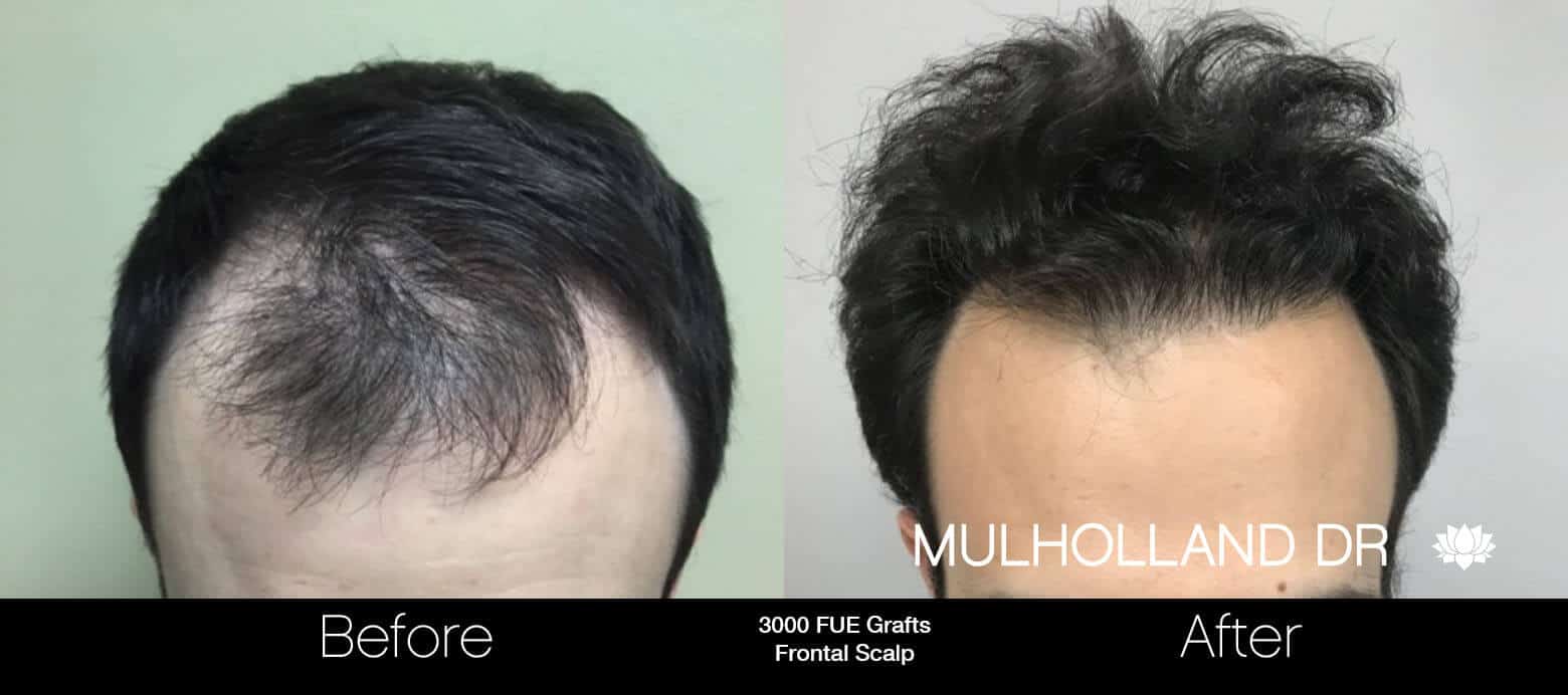 Toronto Neograft Hair Transplant Tps