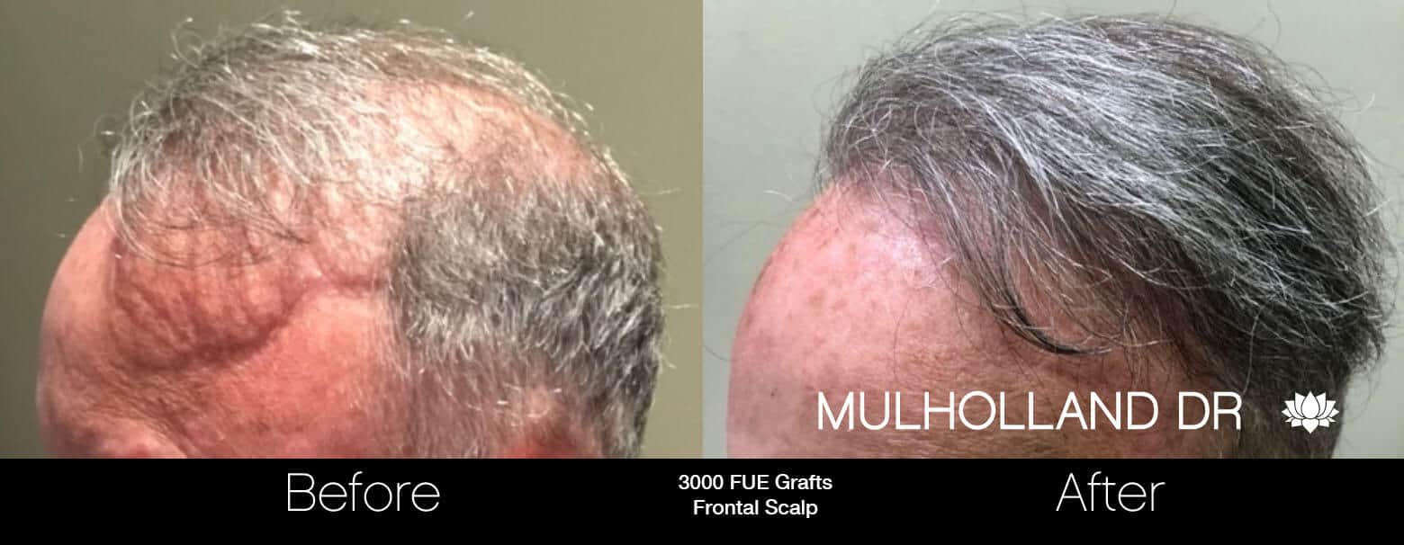 Artas Hair Transplant - Before and After Gallery - Patient Photo 79