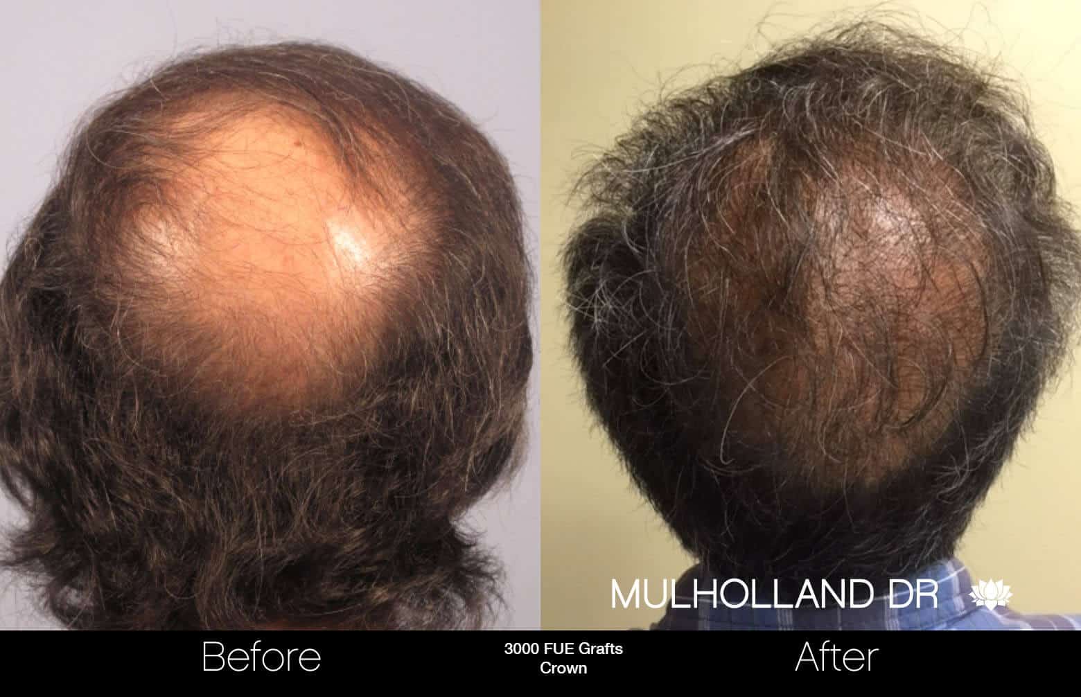 Artas Hair Transplant - Before and After Gallery - Patient Photo 86