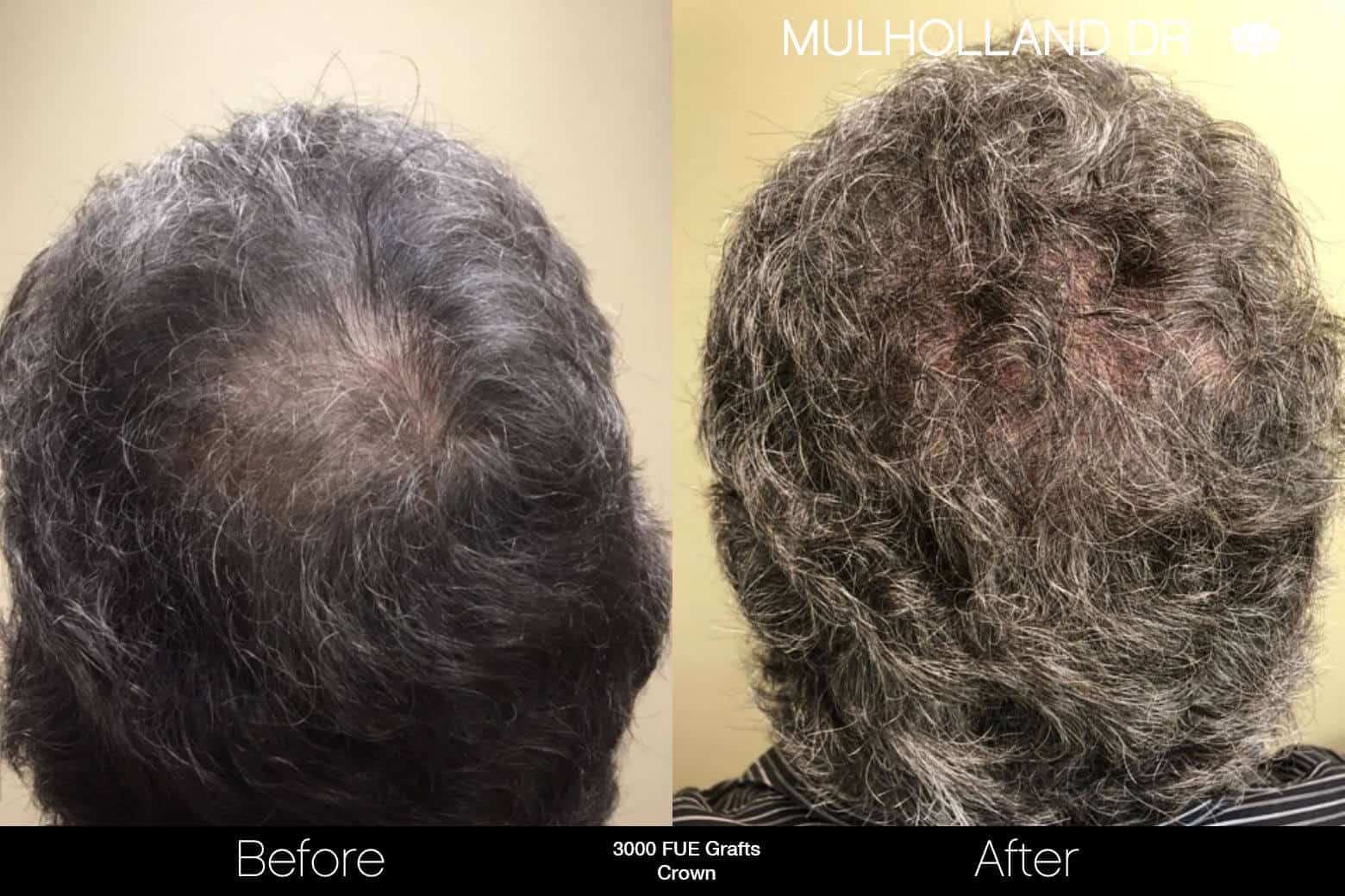 Artas Hair Transplant - Before and After Gallery - Patient Photo 89