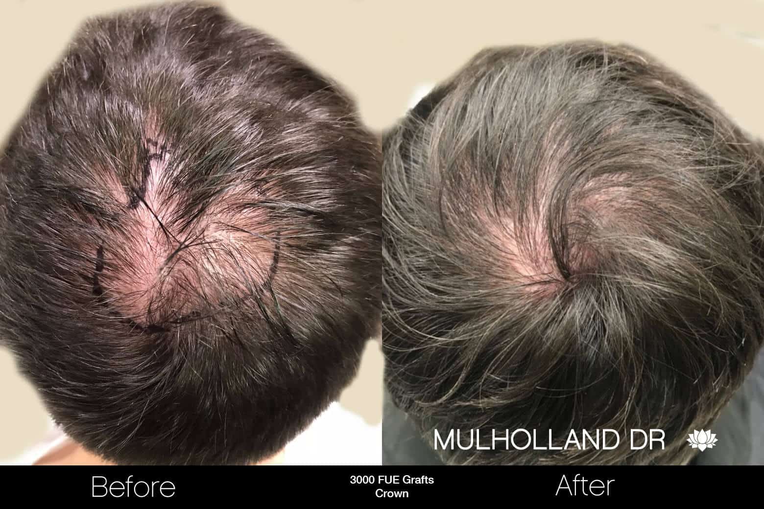 Artas Hair Transplant - Before and After Gallery - Patient Photo 90