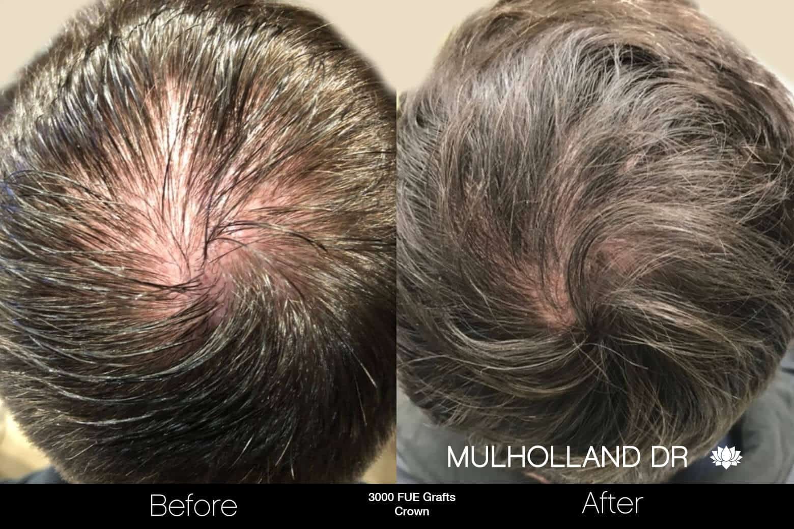 Artas Hair Transplant - Before and After Gallery - Patient Photo 91