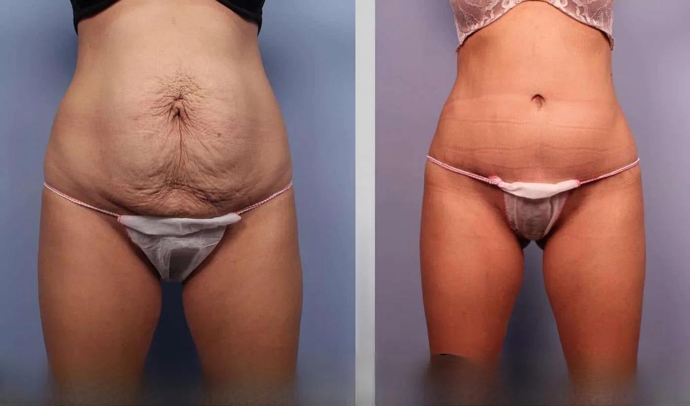 BodyTite Liposuction - Before and After Gallery - Patient Photo 1