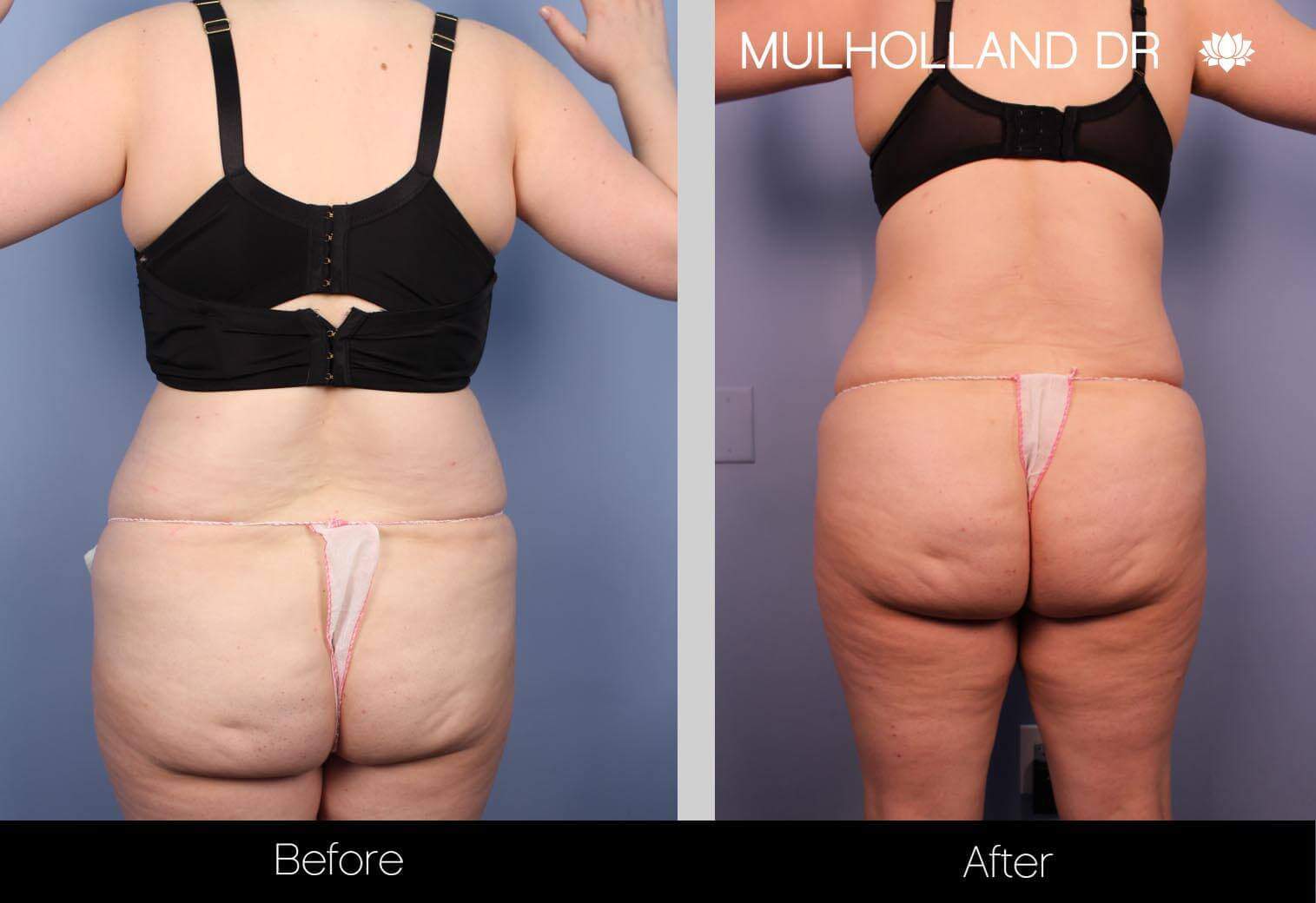 BodyTite Liposuction - Before and After Gallery - Patient Photo 29