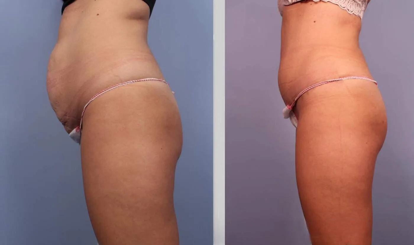 BodyTite Liposuction - Before and After Gallery - Patient Photo 3