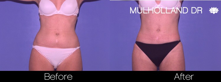 BodyTite Liposuction - Before and After Gallery - Patient Photo 36