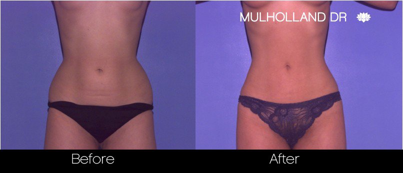 BodyTite Liposuction - Before and After Gallery - Patient Photo 39