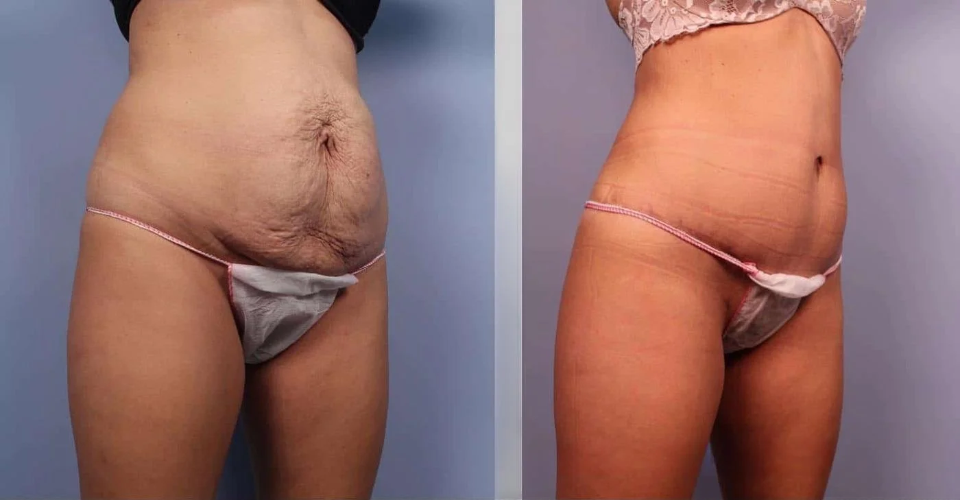 BodyTite Liposuction - Before and After Gallery - Patient Photo 3