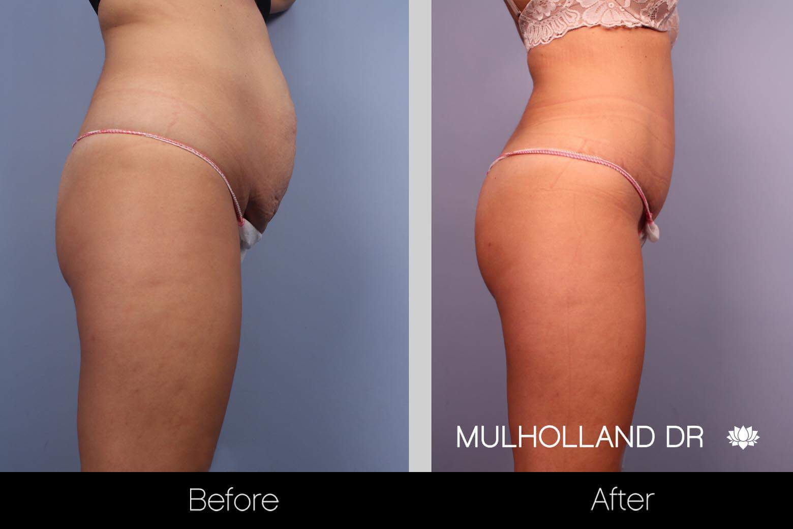 BodyTite Liposuction - Before and After Gallery - Patient Photo 5