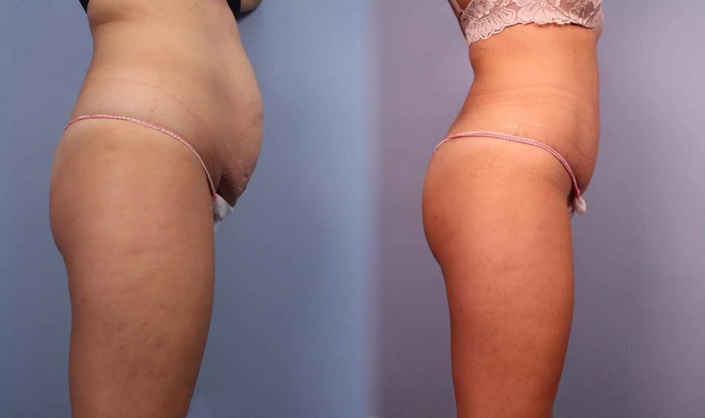 BodyTite Liposuction - Before and After Gallery - Patient Photo 5