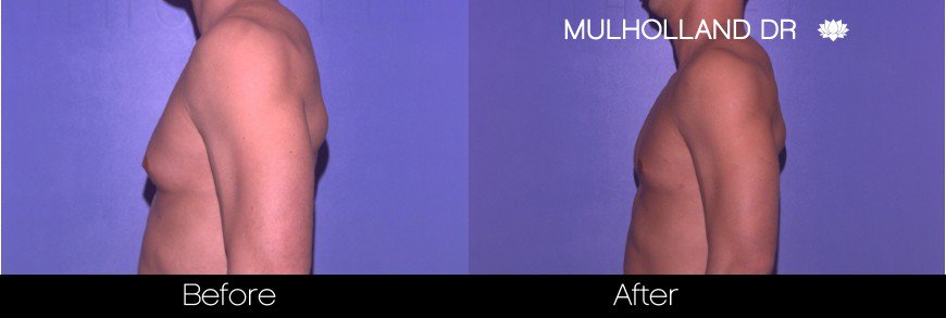 BodyTite Liposuction - Before and After Gallery - Patient Photo 76