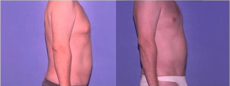 tirzepatide dosing 25 mg ml Tirzepatide dosage chart for weight loss